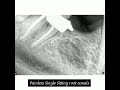 Painless Single Sitting RCT