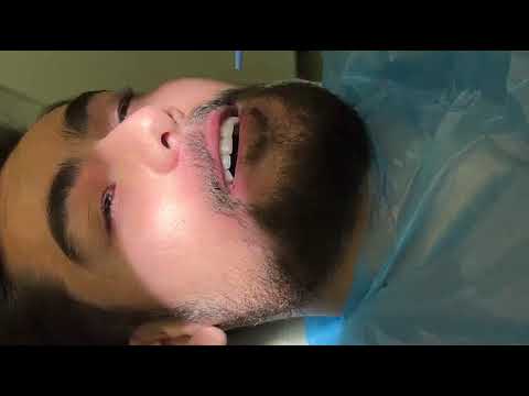 کشیدن دندان عقل به همین راحتی