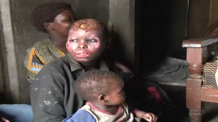 Ekizinga Lambu: Omulwadde w'ensimbu yagwa mu muliro