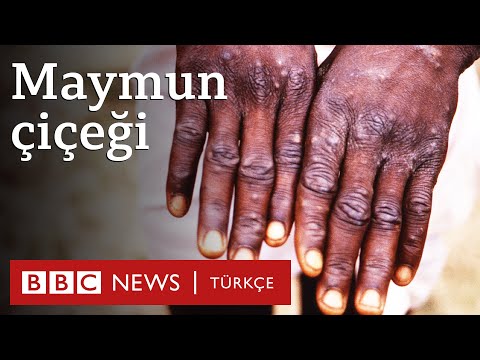 Maymun çiçeği virüsü: \