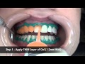 Отбеливание зубов (Klox Fast Mild Version 8) в Стоматологии ВЕДИ