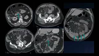 The Many Faces of Small Bowel Ischemia | Free Radiology CME