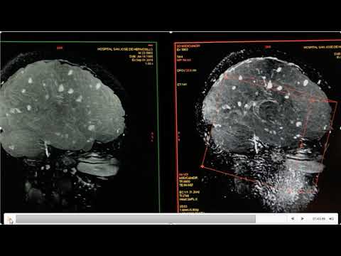 Vídeo: Imágenes De Resonancia Magnética De Esclerosis Múltiple Del Cerebro