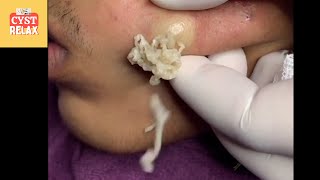 Mega Brufolo, Big cyst Explosion SLOWMOTION