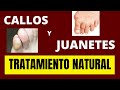 TRATAMIENTO NATURAL DE CALLOS Y JUANETES