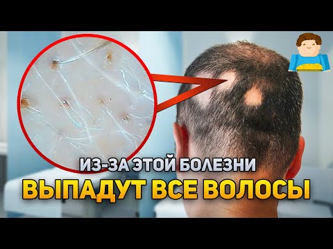 Видео: 3 способа отрастить волосы после грибковой инфекции кожи головы