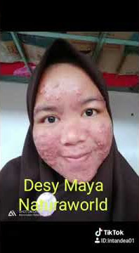 Ini RAHASIA JERAWAT HILANG ternyata dengan NATURA BEAUTY SPRAY