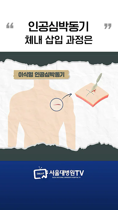 인공심박동기 체내 삽입 과정 #1분건강
