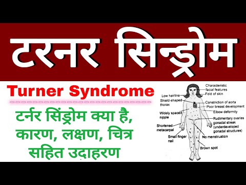 टर्नर सिंड्रोम क्या है | लक्षण, कारण, उदाहरण | turner&rsquo;s syndrome in hindi | turner syndrome symptoms