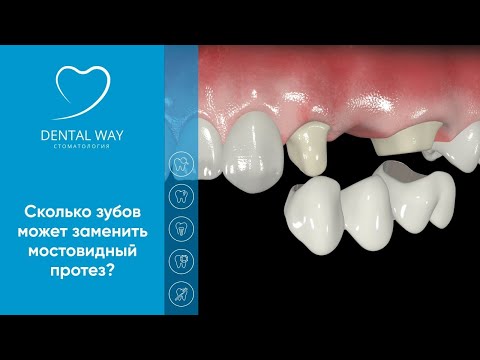 Сколько зубов может заменить мостовидный протез ?