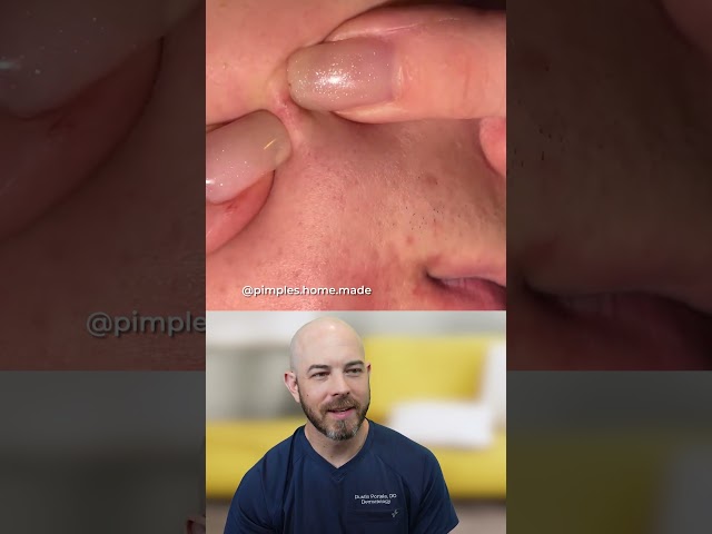 Why You Shouldn't Pop Pimples With Your Nails
