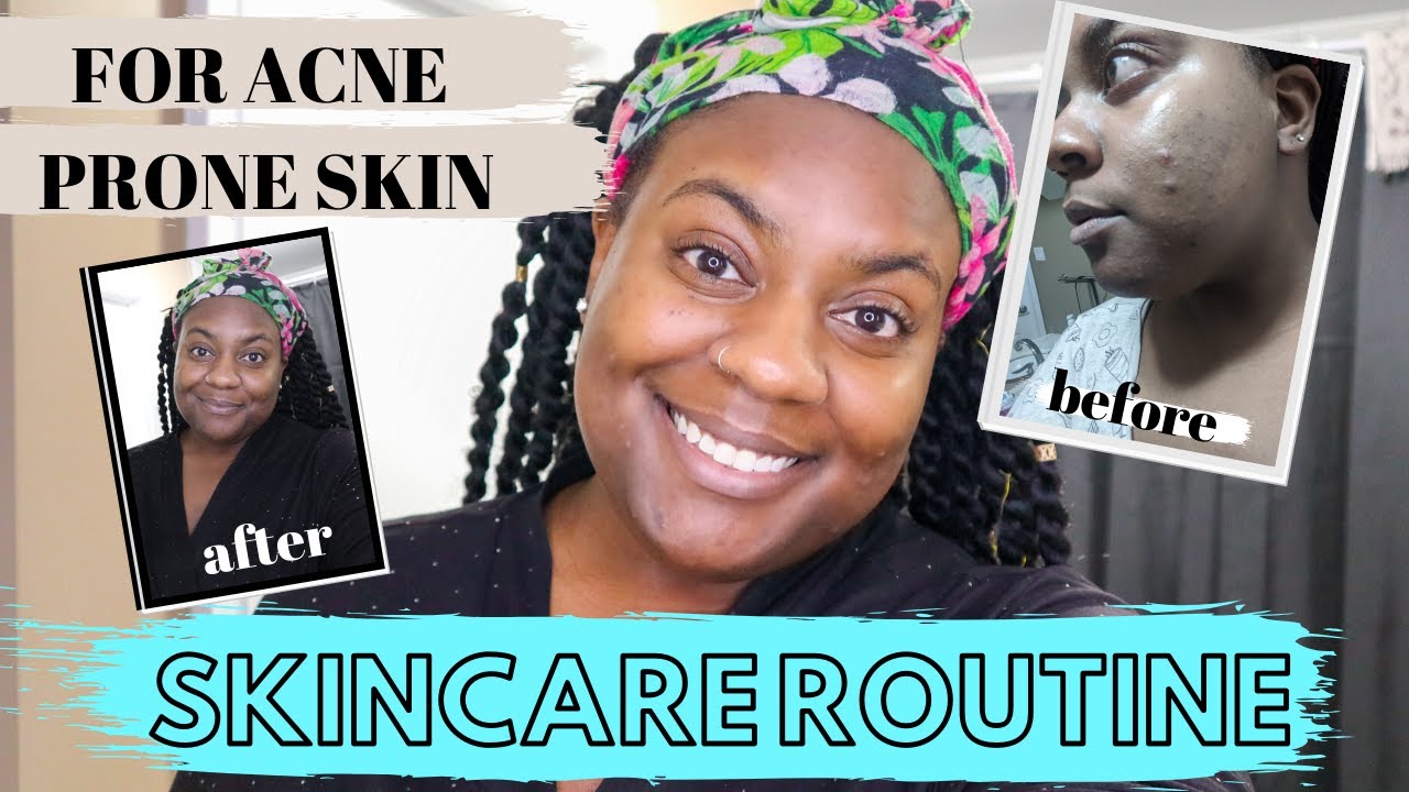 MORNING SKINCARE ROUTINE FOR ACNE PRONE SKIN | HOW TO GET RID OF ACNE ...