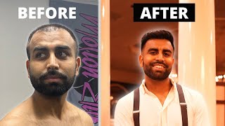 MY 0 TO 18 MONTH TURKEY HAIR TRANSPLANT TRANSFORMATION | SHOCKING RESULTS!