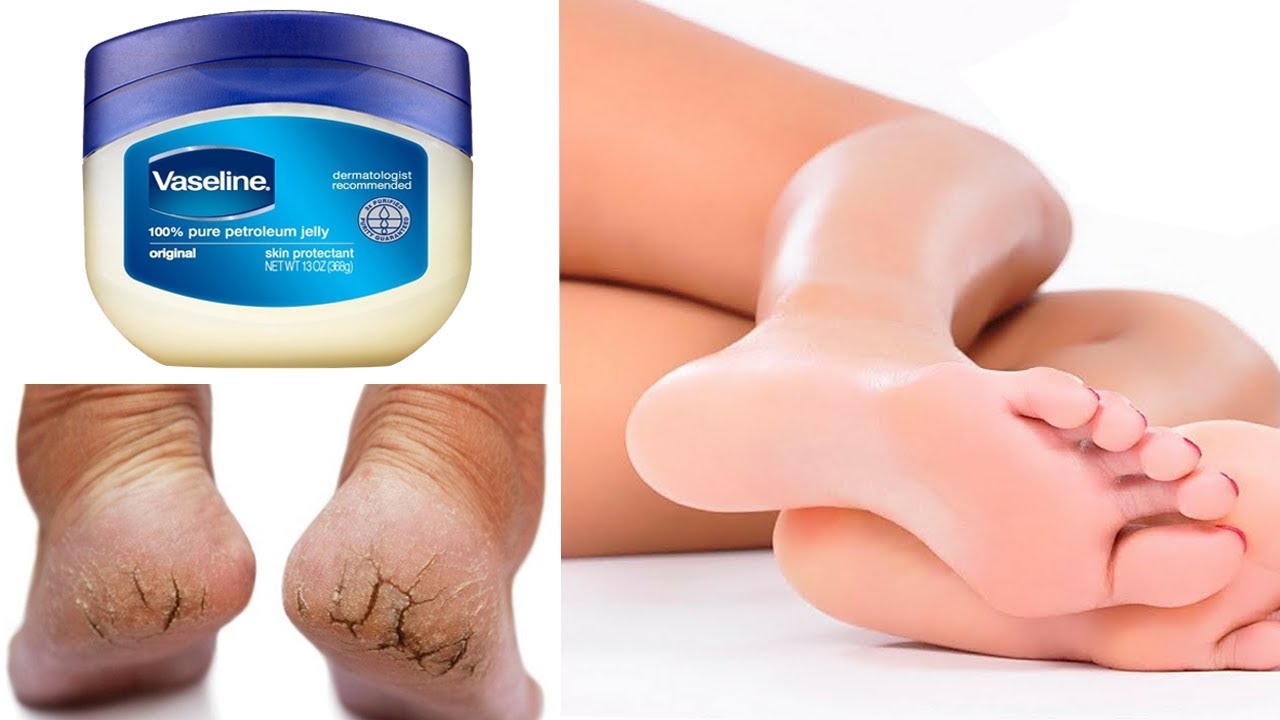 DO THIS SIMPLE HOME REMEDY WITH VASELINE TO GET RID OF CRACKED HEELS IN 3  DAYS - YouTube