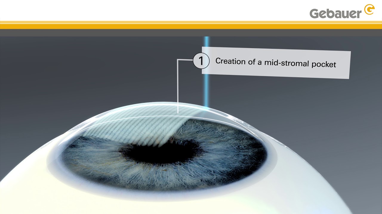 Keratoconus treatment using LIKE (mid-stromal pocket) - Lenticular Intrastromal Keratoplasty
