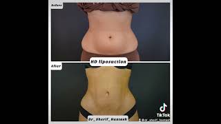 HD liposuction نحت الجسم