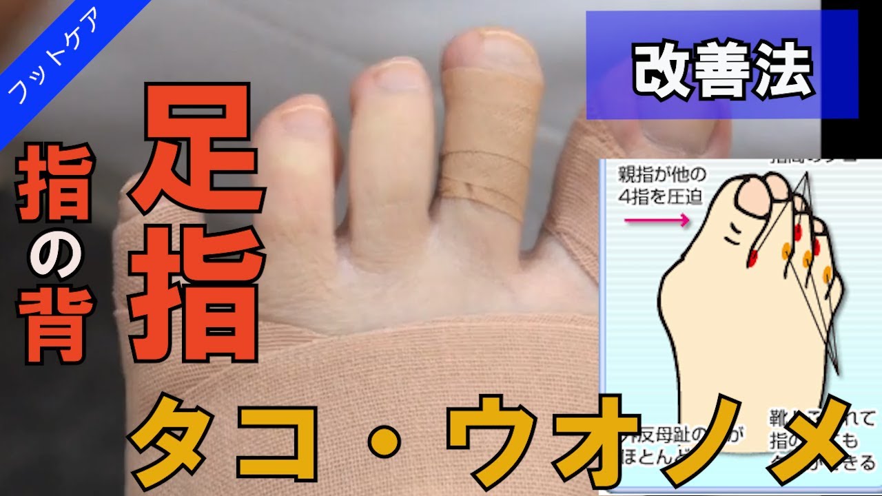 改善法 指の背と指間のタコと痛み Youtube