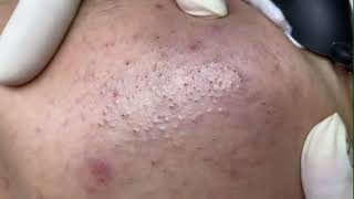 Acne On man Cheek 2024| Acne Treatment Nhat Bang