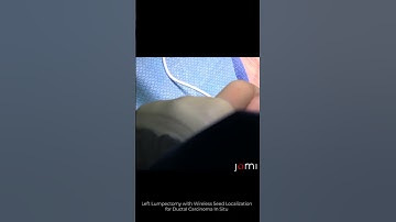 Left Lumpectomy with Wireless Seed Localization for Ductal Carcinoma In Situ