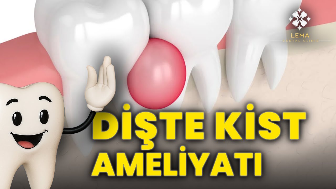 🤍 (с субтитрами) Что такое операция по удалению кисты зуба? Как она проводится? — Lema