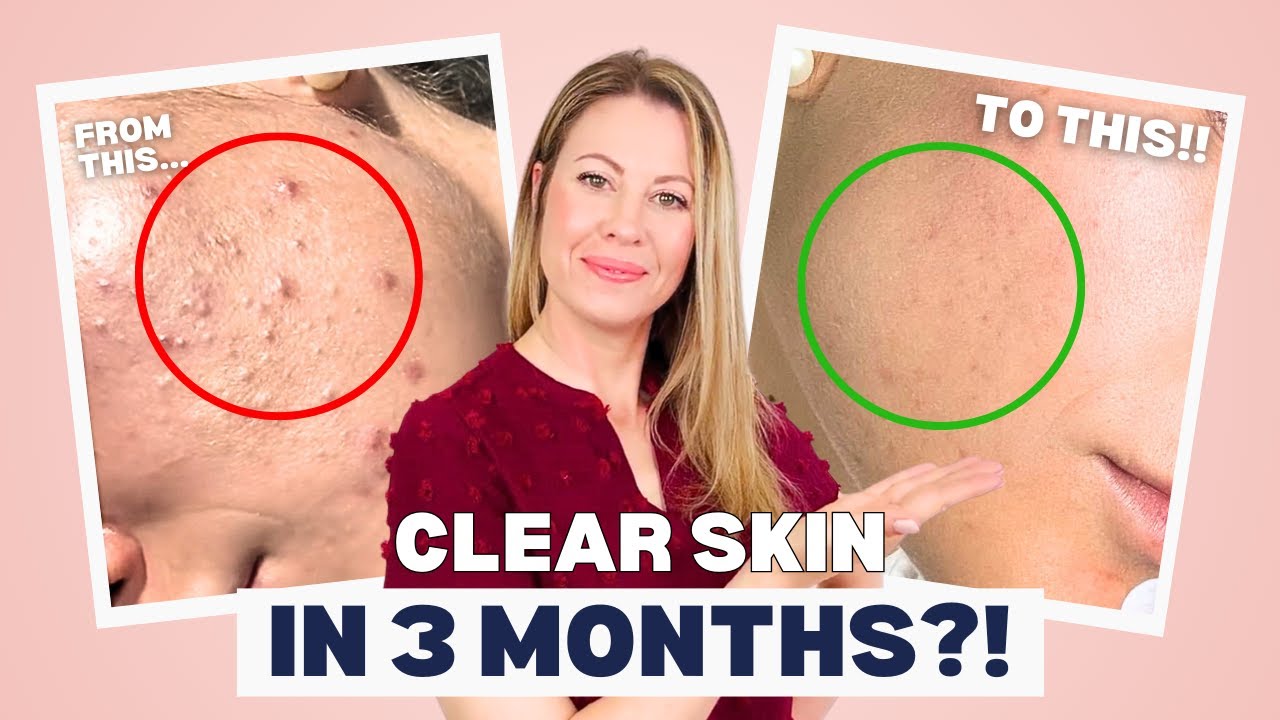 Acne Success Story: Clear Skin After $1,000s on Failed Acne Fixes