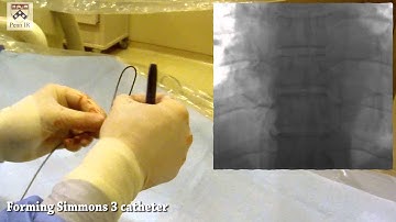 Preview JVIR Video Article: Adrenal Vein Sampling