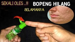 CARA MENGHILANGKAN BEKAS JERAWAT BOPENG | dr. Vania Utami