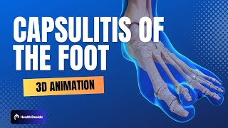 Capsulitis - Pain in the Ball of the Foot