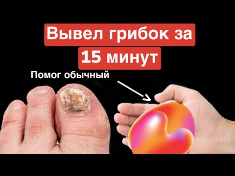 ГРИБОК НОГТЕЙ можно убрать за 15 минут обычным... Это есть дома у каждого