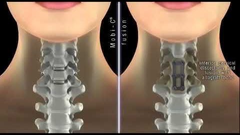Mobi C Cervical Disc vs Fusion Animation Video — Two Level