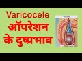 Varicocele operation side effect.डॉ मनीष गुप्ता, होम्योपैथ, रायबरेली, U.P., Mob 7607480018.