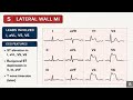Master All Myocardial Infarction ECGs in 8 Minutes | Complete ECG Guide #fcps #medicine #cardiology