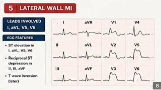 Master All Myocardial Infarction ECGs in 8 Minutes | Complete ECG Guide #fcps #medicine #cardiology