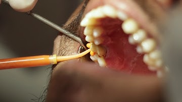 How to take a Triple Tray Impression