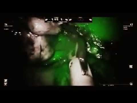 Single Site Robotic Cholecystectomy with Firefly Fluorescence imaging - Dr. Babak Eghbalieh