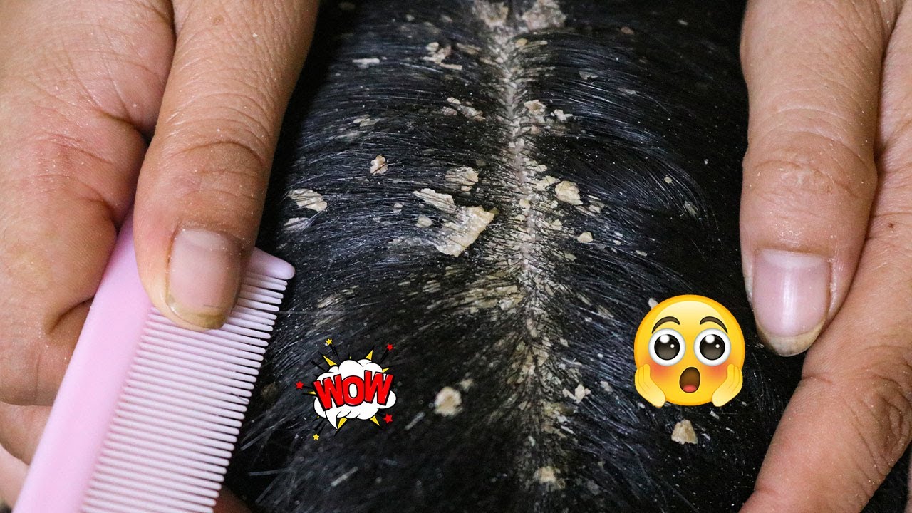 Wow to remove dandruff black hair 51 YouTube