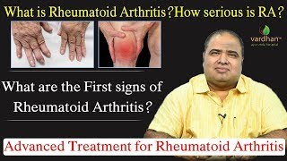 Ayurvedic Approach to Rheumatoid Arthritis | Treatment & Relief by Dr. Kranti Vardhan