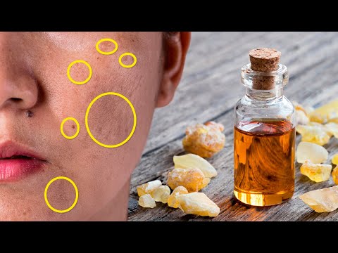 How to Remove Age Spots with Frankincense Oil