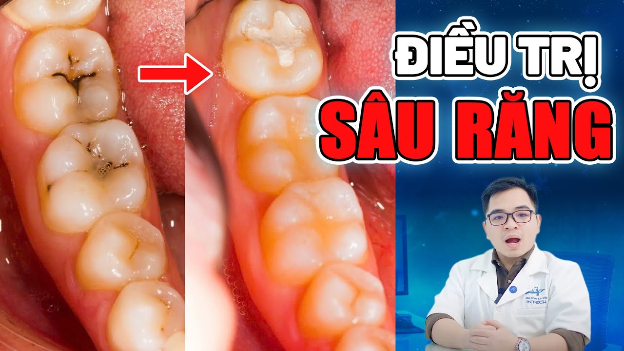 Outline Video Các Cách Điều Trị Sâu Răng Dứt Điểm| Chữa Sâu Răng Tại Nhà Liệu Có Hiệu Quả?