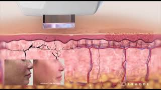 Ipl Treatment For Rejuvenation And Anti-Aging