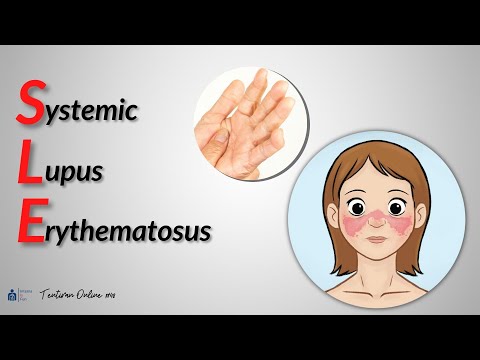 Systemic Lupus Erythematosus 101 | TENTIRAN ONLINE
