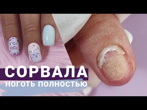 Ноготь таки ОТВАЛИЛСЯ ? Травматический ОНИХОЛИЗИС аппаратная зачистка. Маникюр с РИСУНКОМ