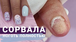 Ноготь таки ОТВАЛИЛСЯ 😰 Травматический ОНИХОЛИЗИС аппаратная зачистка. Маникюр с РИСУНКОМ