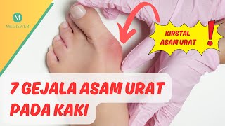 Jangan Salah Ini 7 Gejala Asam Urat Pada Kaki