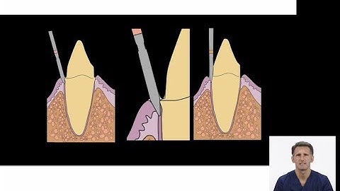 Preview The Flame bur and the Vertiprep: What is wrong..?