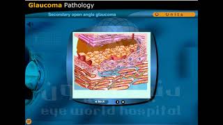 primary open angle glaucoma and secondary open angle glaucoma