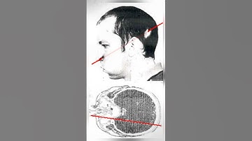 The Man Who Survived a Particle Beam Through His Head ⚡😳