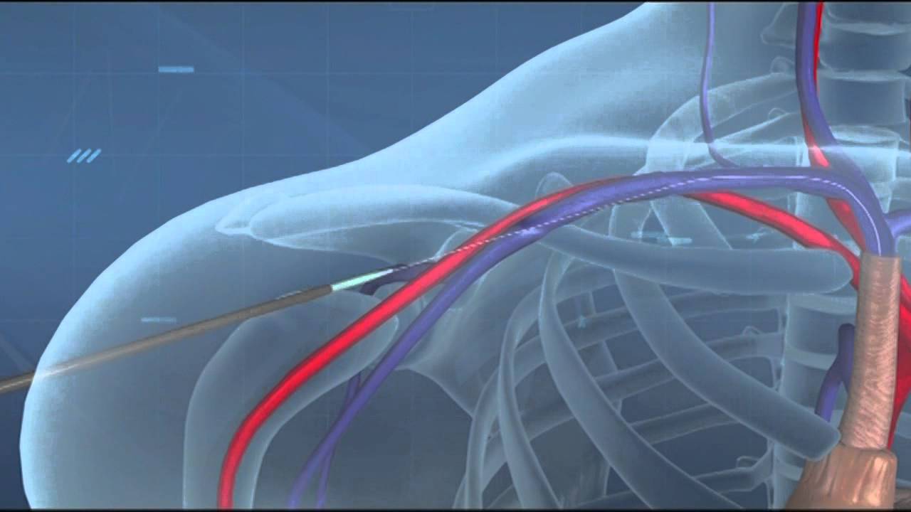 Medisprof: Ce sunt camerele implantabile?