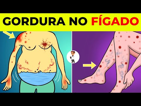 CUIDADO Esses são os 5 sintomas que alertam que você tem GORDURA NO FÍGADO