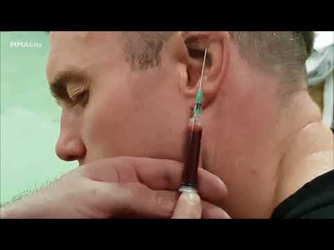 Video of an MMA fighter draining his cauliflower ear in the gym